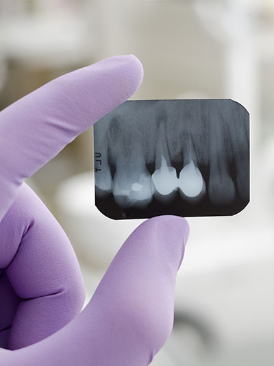 root canal retreatment
