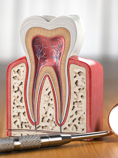 root canal therapy