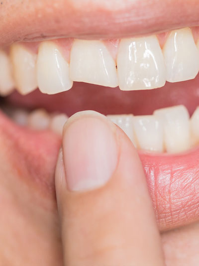 traumatic dental injuries